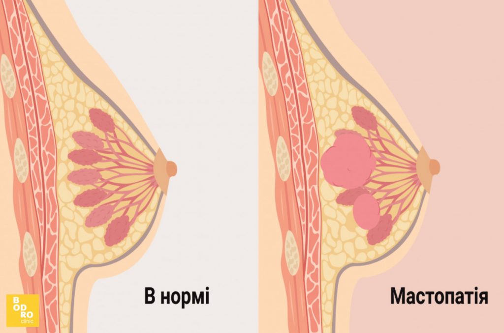 Мастопатія