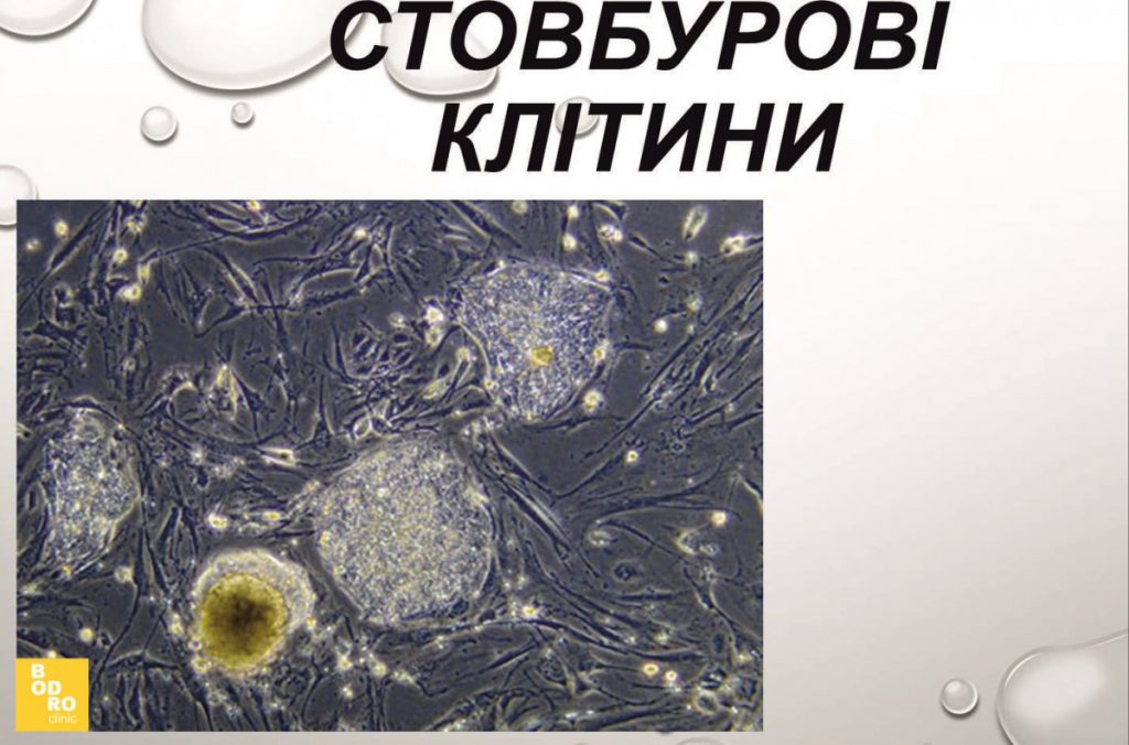 Терапія стовбуровими клітинами BMAC