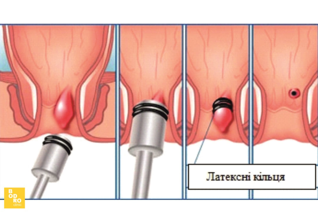 Латексне лігування геморою