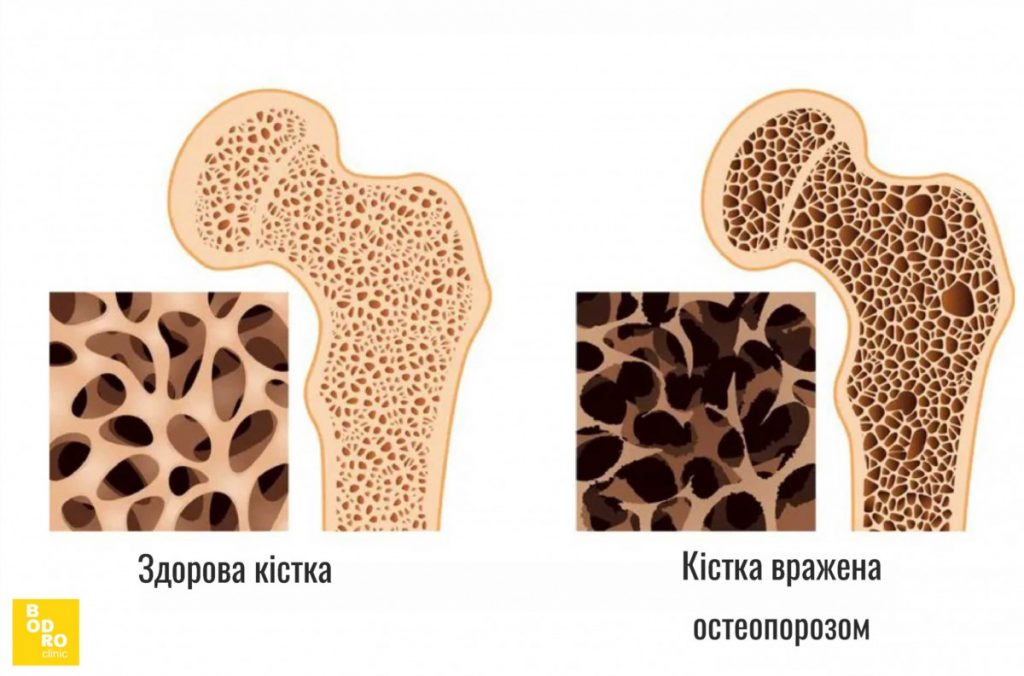 остеопороз