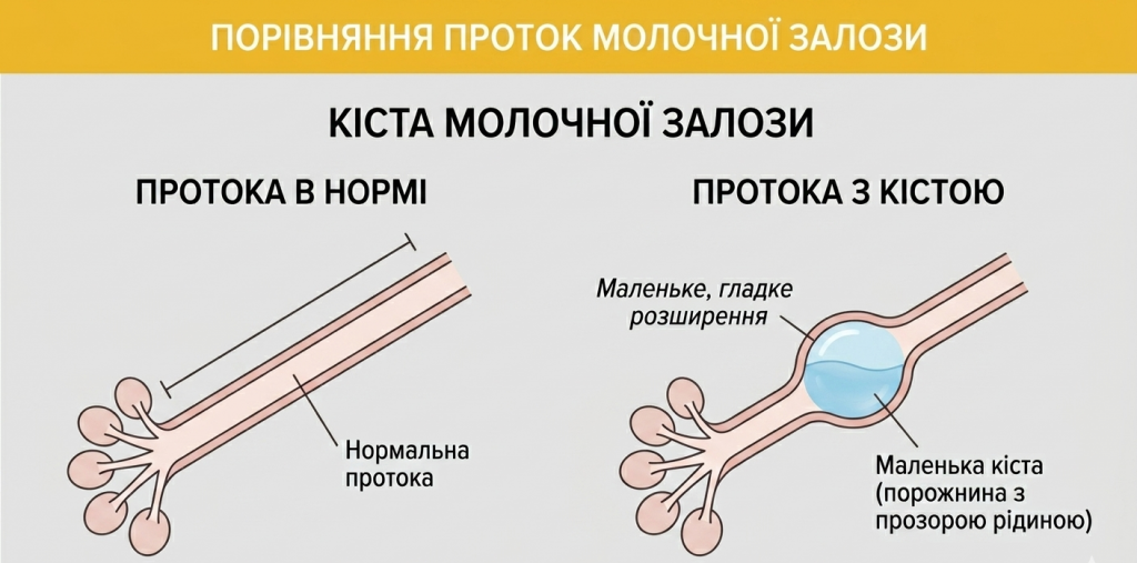Кіста молочної залози